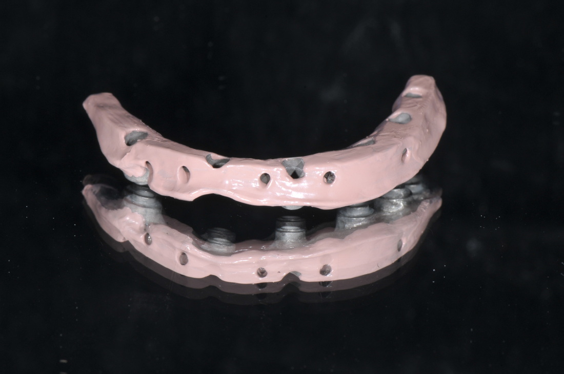 Hybrid Implant