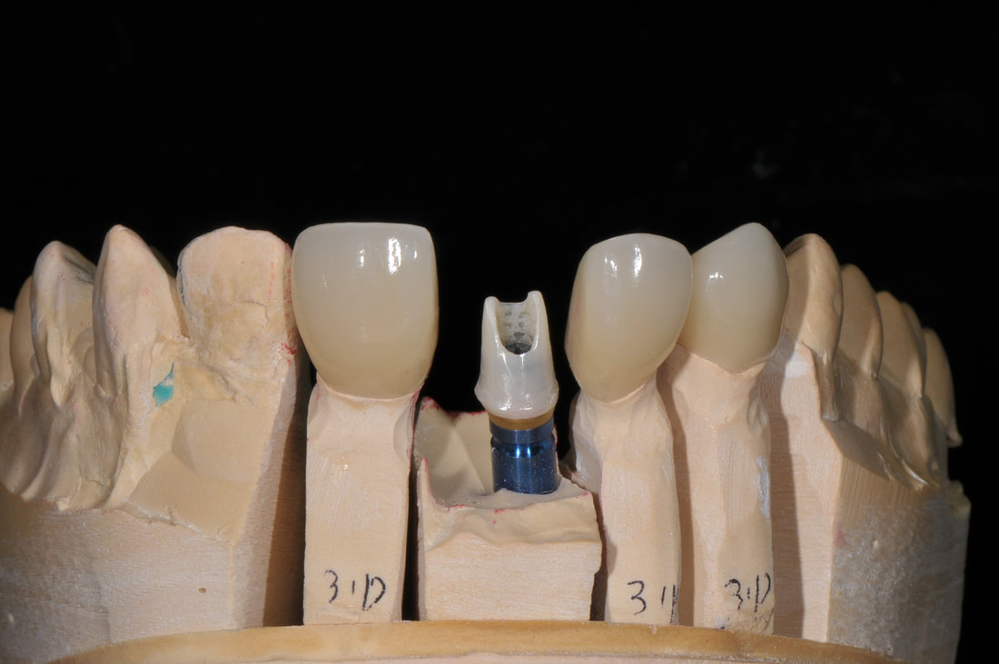 Custom Abutment