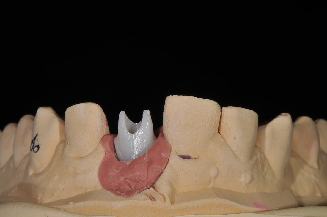 Custom Abutment