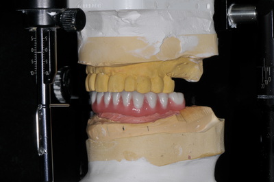 Hybrid Implant