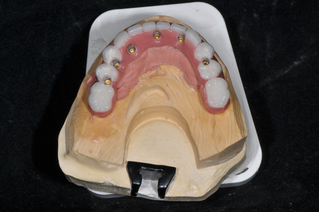 Hybrid Implant