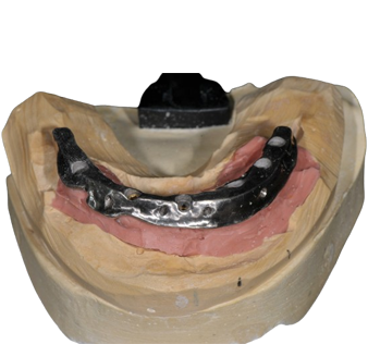 Hybrid Implant