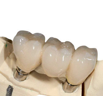 Implant Bridge