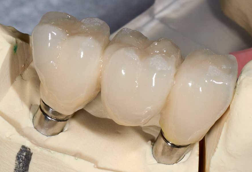 Implant Crown