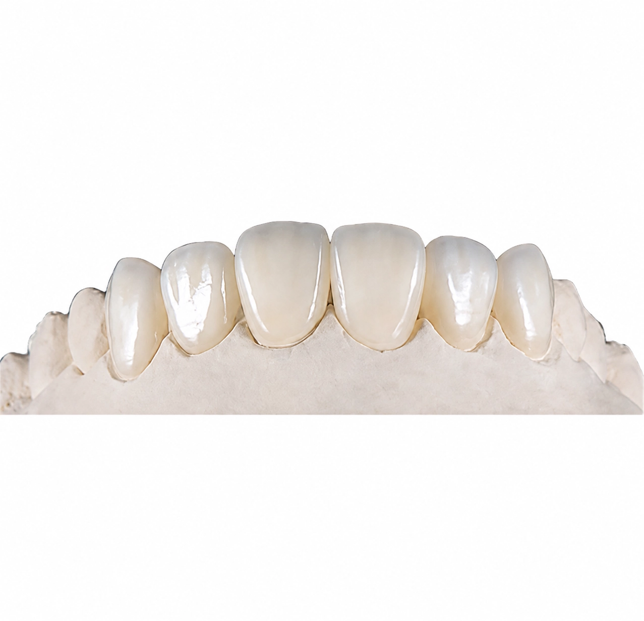 Veneer