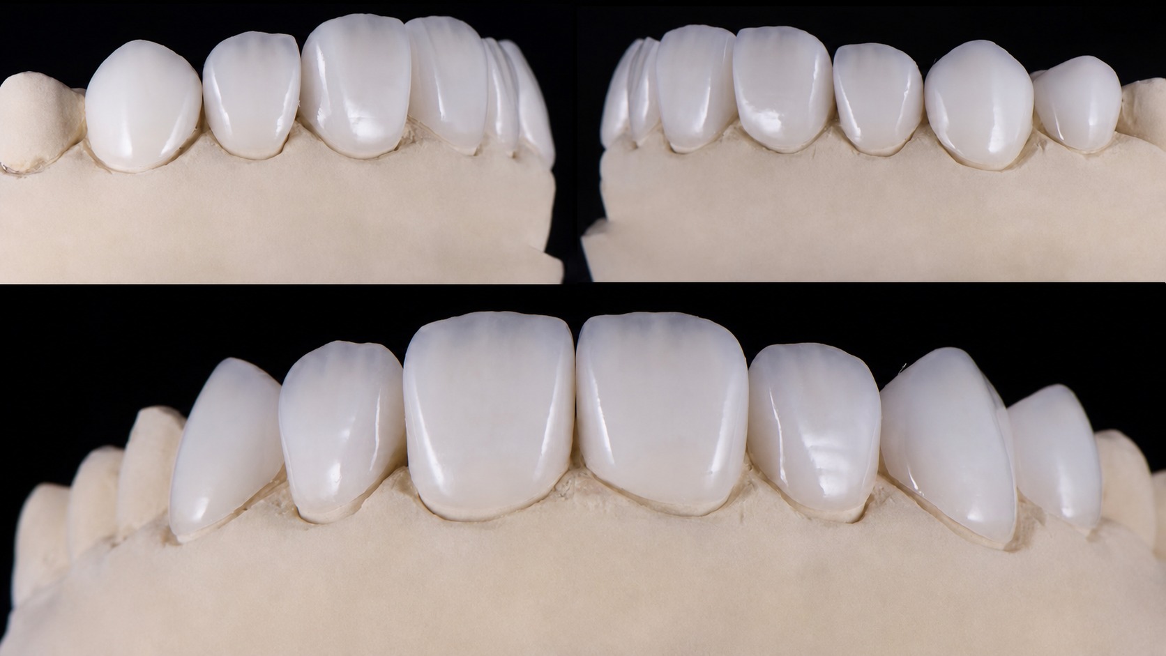 Veneer
