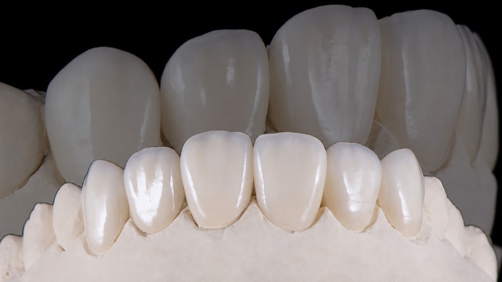 Veneer