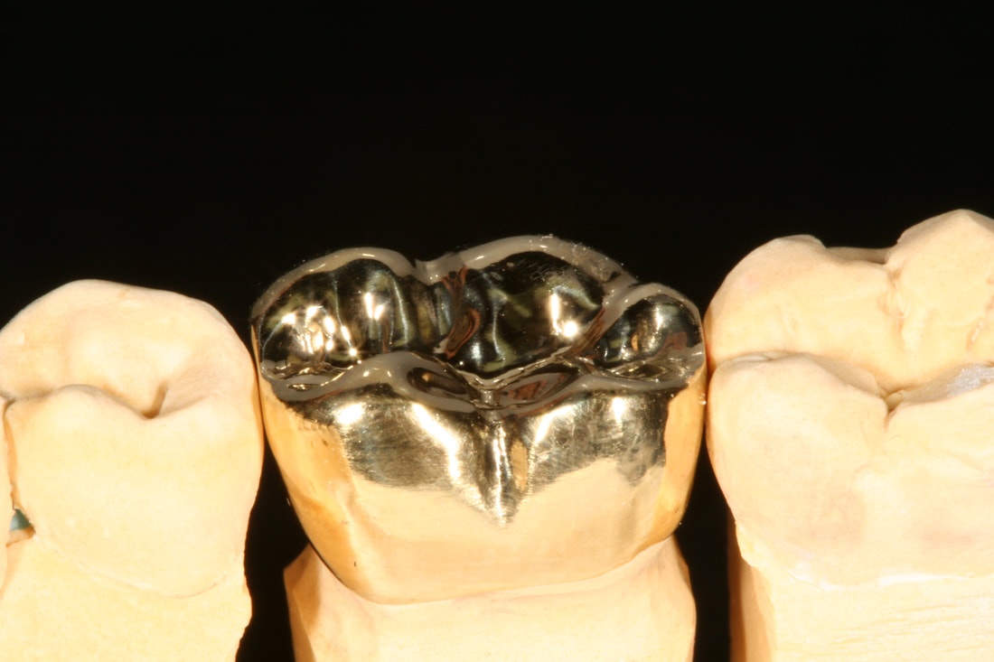 Full Metal Crown