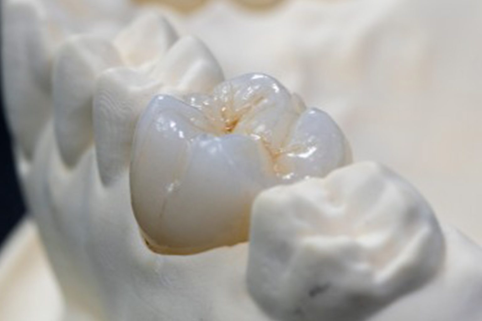 Full Zirconia