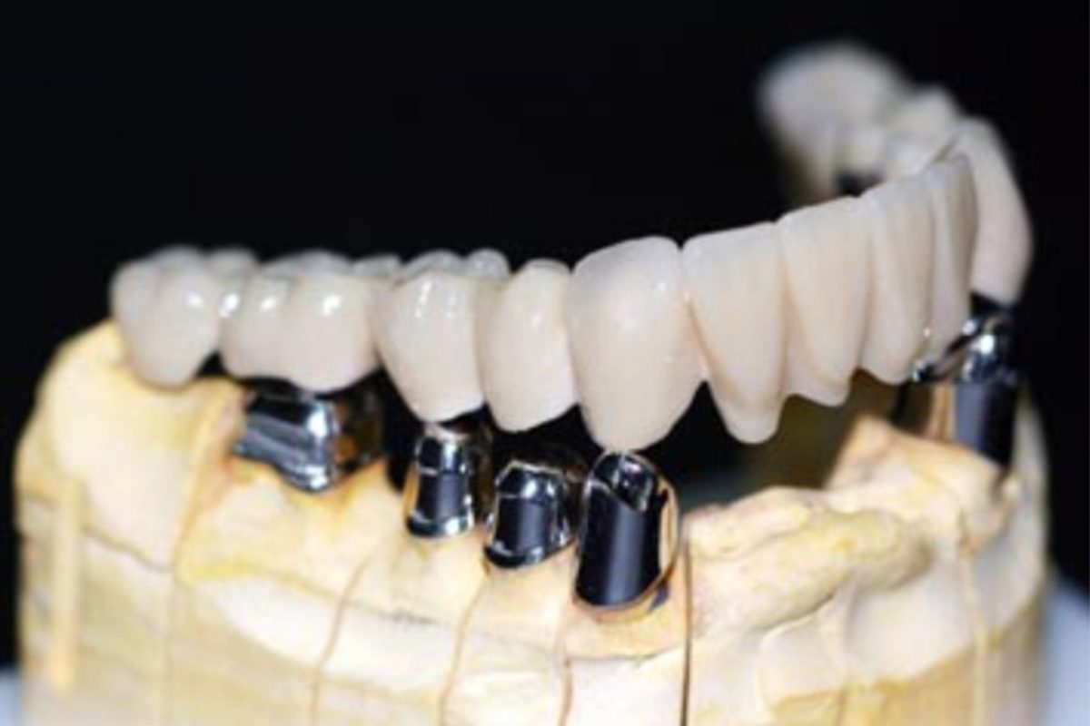 custom Titainium Implants with crown& bridge